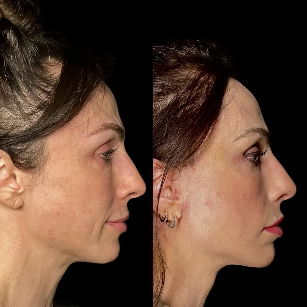 Before and after deep plane facelift — 48-year-old woman, right profile view, 6mo post-op by Dr. Diego Ricardo
