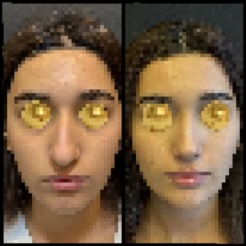 Before and after — Dr. Dilqem Meherremov