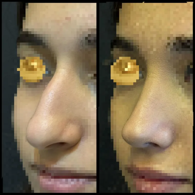 Before and after — Dr. Dilqem Meherremov