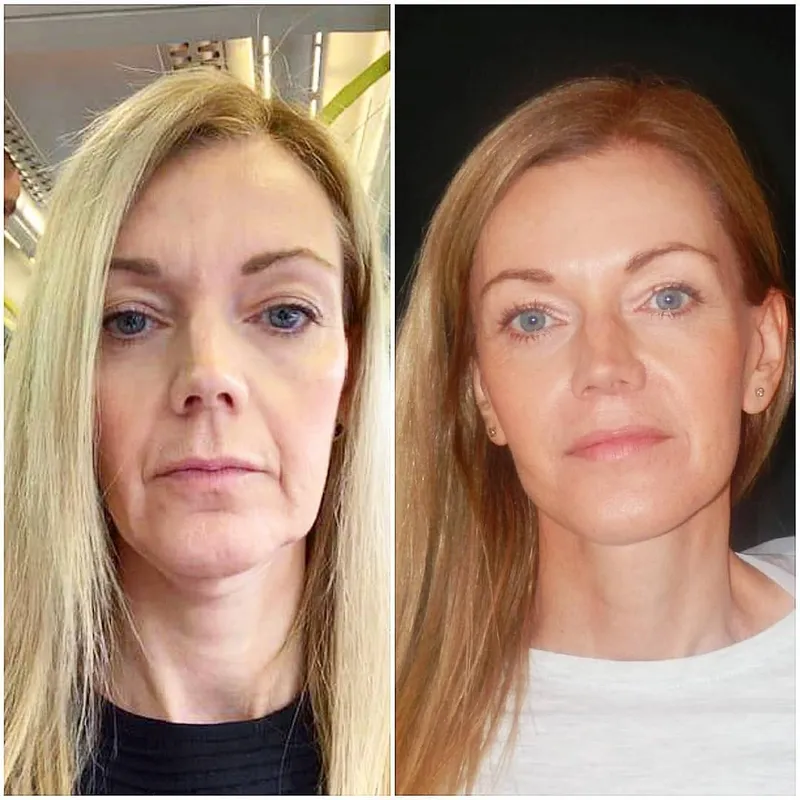 Before and after — Dr. Dirk Kremer
