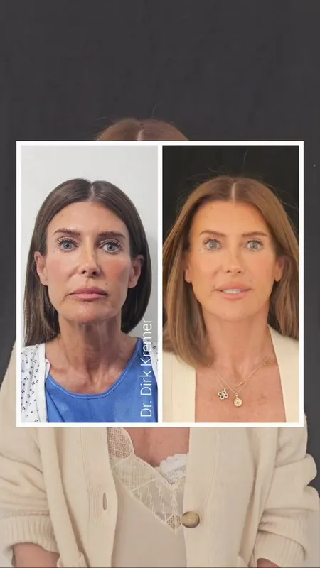 Before and after — Dr. Dirk Kremer