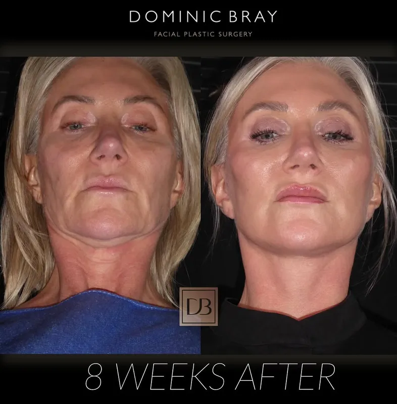 Before and after deep plane facelift — -1-year-old patient, frontal view by Dr. Dominic Bray