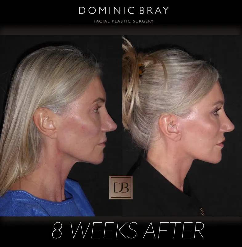 Before and after deep plane facelift — -1-year-old patient, frontal view by Dr. Dominic Bray
