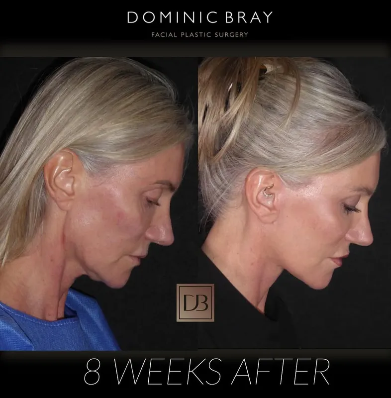 Before and after deep plane facelift — -1-year-old patient, frontal view by Dr. Dominic Bray
