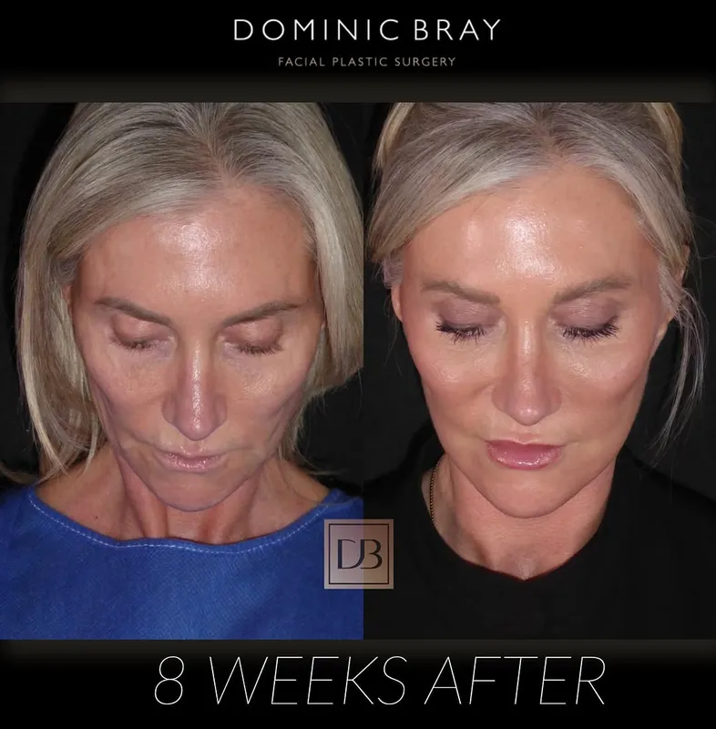 Before and after deep plane facelift — -1-year-old patient, frontal view by Dr. Dominic Bray