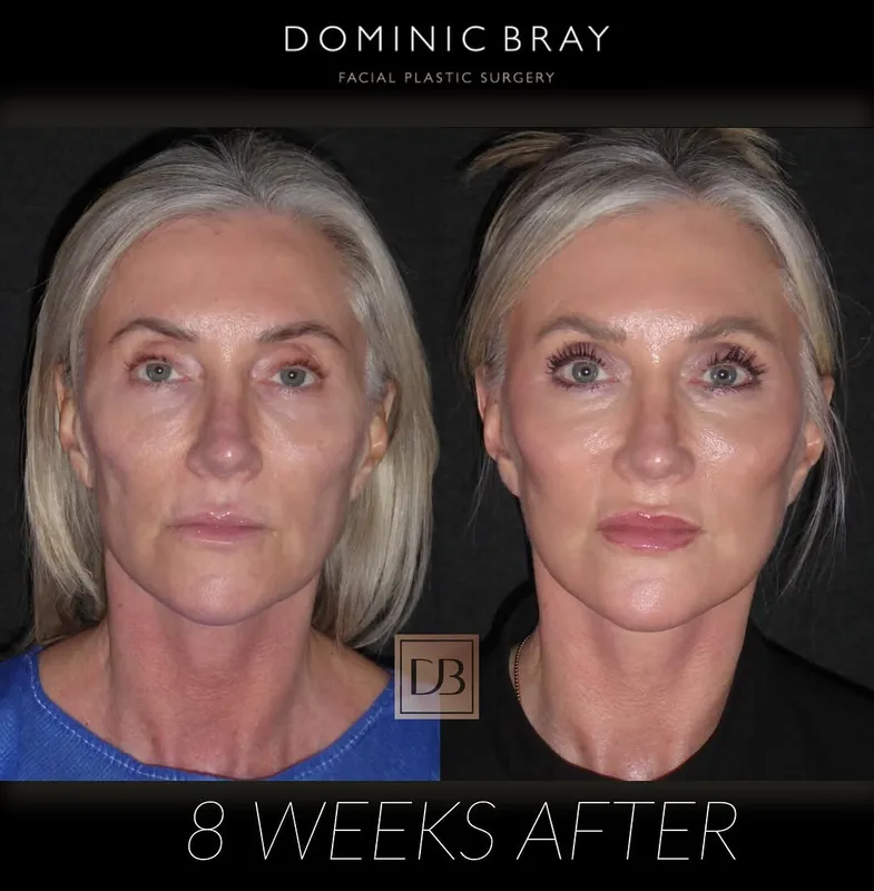 Before and after deep plane facelift — -1-year-old patient, frontal view by Dr. Dominic Bray