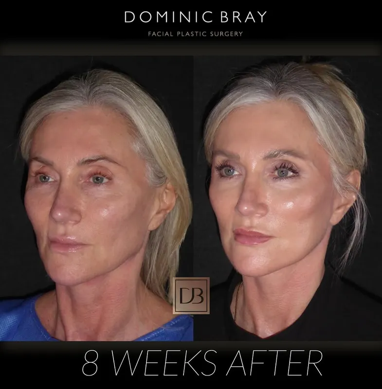 Before and after deep plane facelift — -1-year-old patient, frontal view by Dr. Dominic Bray