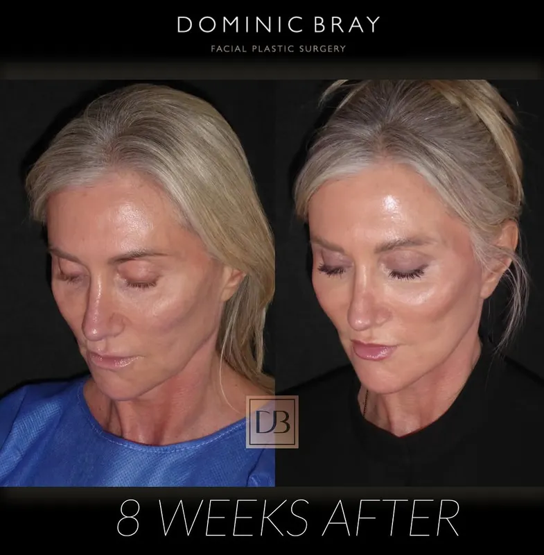 Before and after deep plane facelift — -1-year-old patient, frontal view by Dr. Dominic Bray