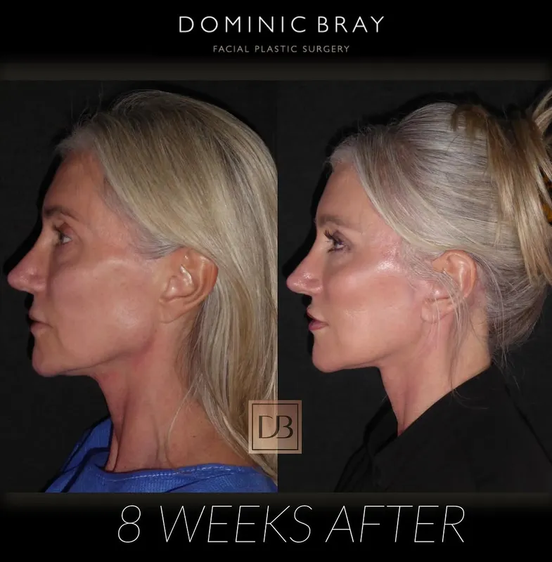 Before and after deep plane facelift — -1-year-old patient, frontal view by Dr. Dominic Bray