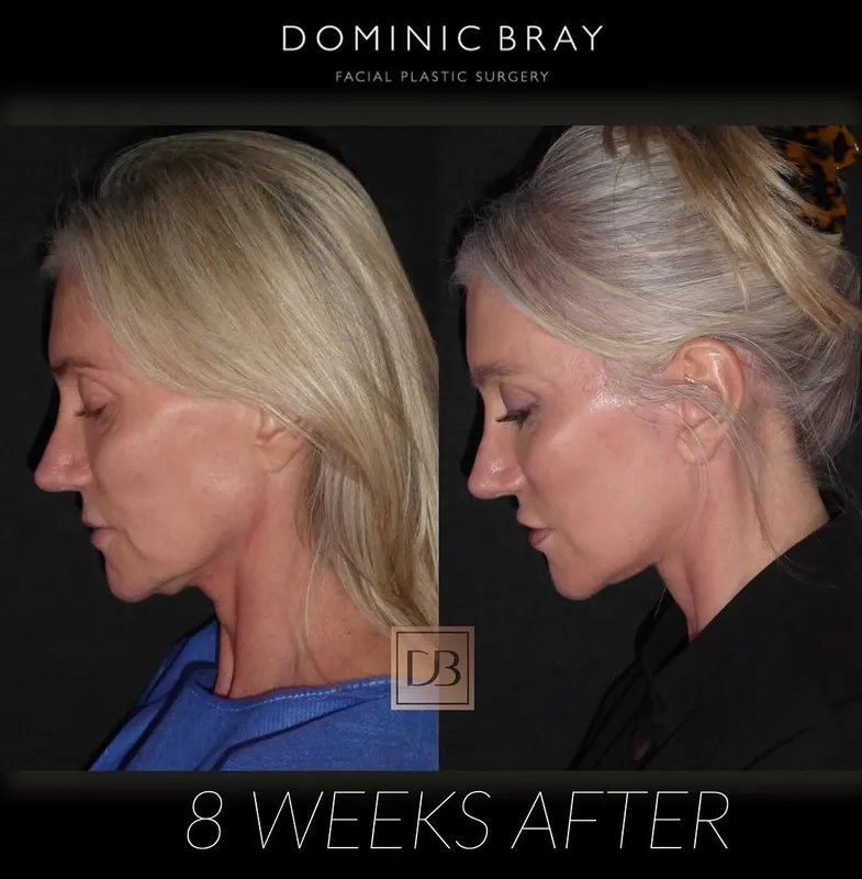 Before and after deep plane facelift — -1-year-old patient, frontal view by Dr. Dominic Bray