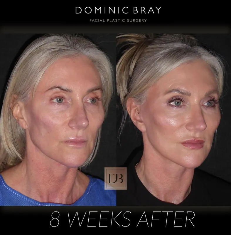 Before and after deep plane facelift — -1-year-old patient, frontal view by Dr. Dominic Bray