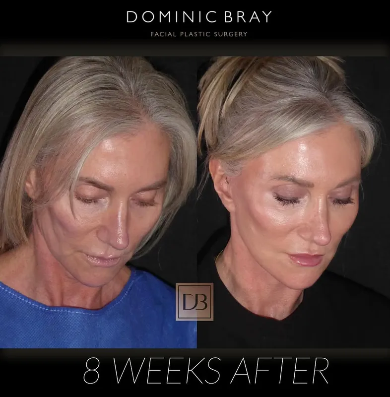 Before and after deep plane facelift — -1-year-old patient, frontal view by Dr. Dominic Bray