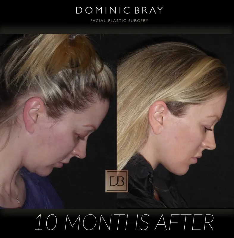 Before and after deep plane facelift — -1-year-old patient, frontal view by Dr. Dominic Bray