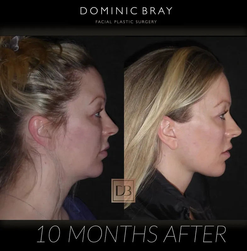 Before and after deep plane facelift — -1-year-old patient, frontal view by Dr. Dominic Bray