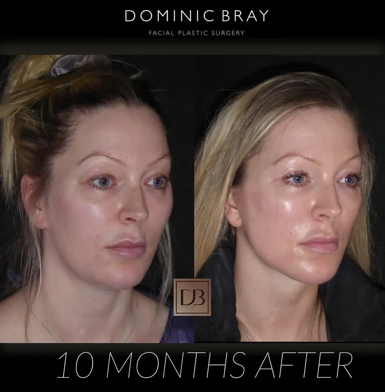 Before and after deep plane facelift — -1-year-old patient, frontal view by Dr. Dominic Bray