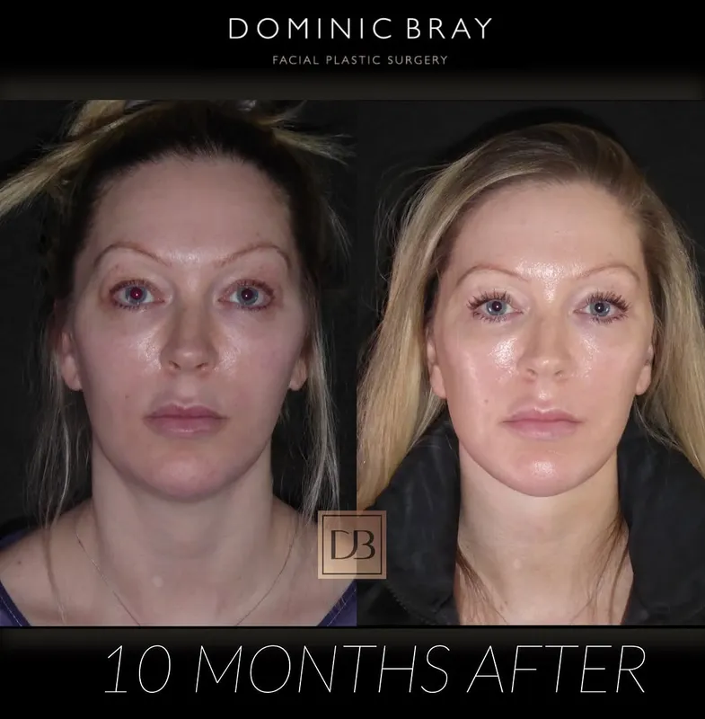 Before and after deep plane facelift — -1-year-old patient, frontal view by Dr. Dominic Bray