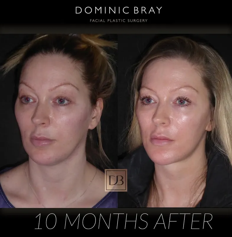 Before and after deep plane facelift — -1-year-old patient, frontal view by Dr. Dominic Bray