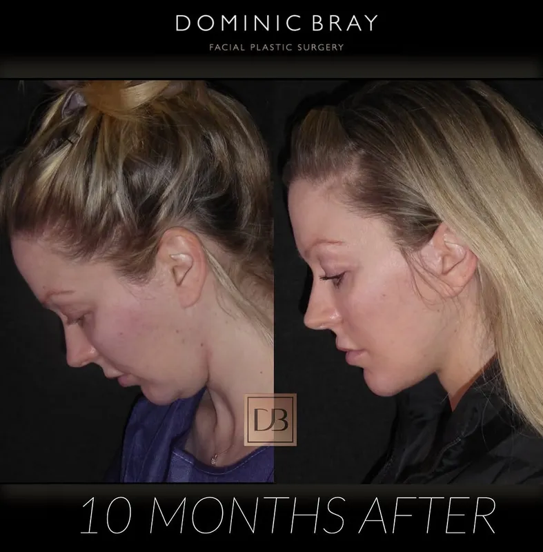 Before and after deep plane facelift — -1-year-old patient, frontal view by Dr. Dominic Bray