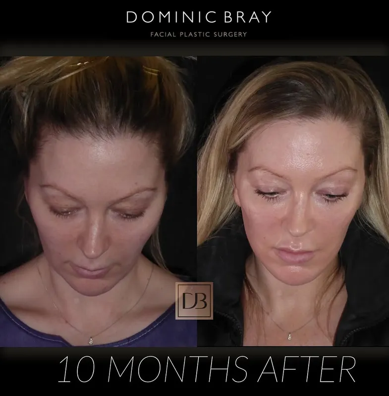 Before and after deep plane facelift — -1-year-old patient, frontal view by Dr. Dominic Bray
