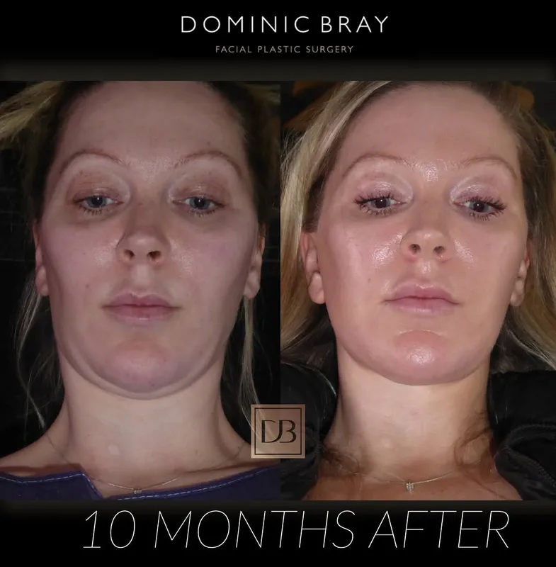 Before and after deep plane facelift — -1-year-old patient, frontal view by Dr. Dominic Bray