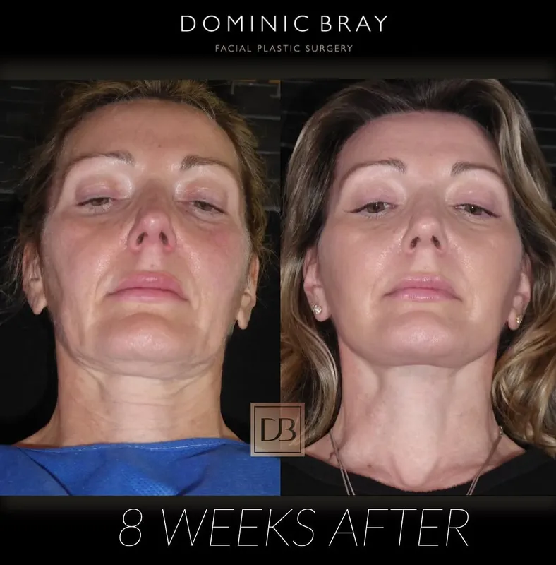 Before and after deep plane facelift — -1-year-old patient, frontal view by Dr. Dominic Bray