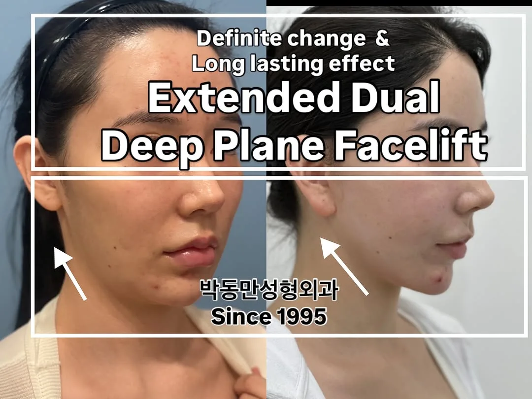 Before and after deep plane facelift — 28-year-old woman, oblique right view, 12mo post-op by Dr. Dong Man Park