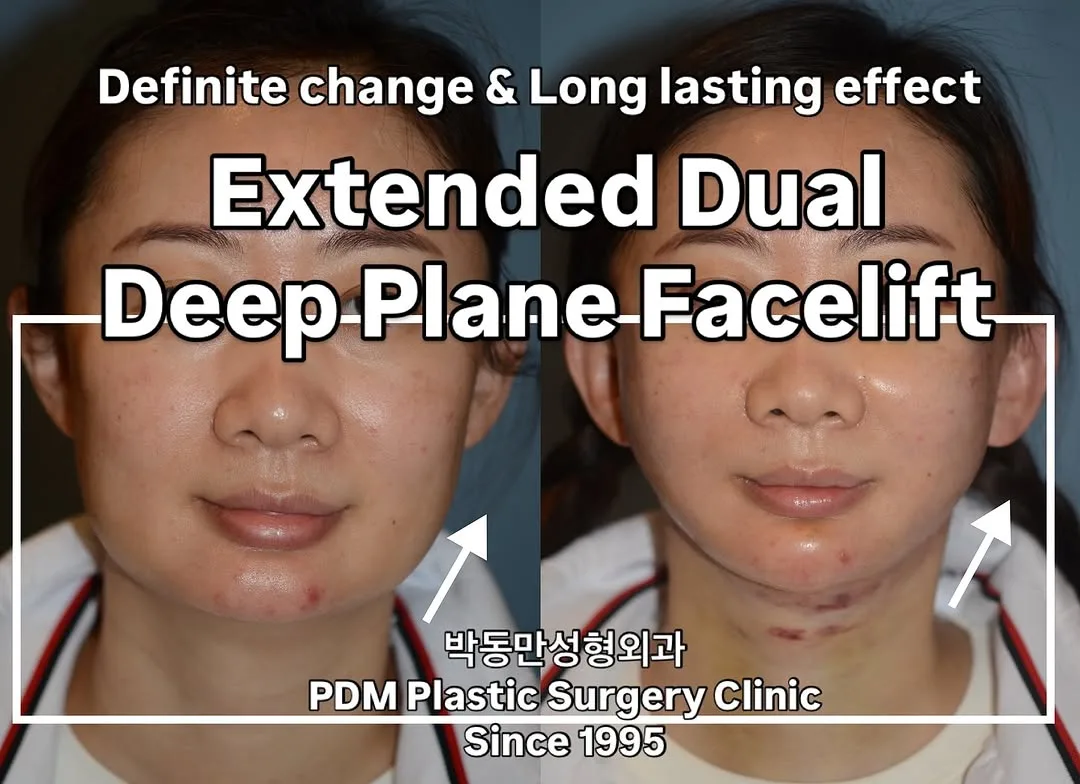 Before and after deep plane facelift — 25-year-old woman, frontal view, 6mo post-op by Dr. Dong Man Park