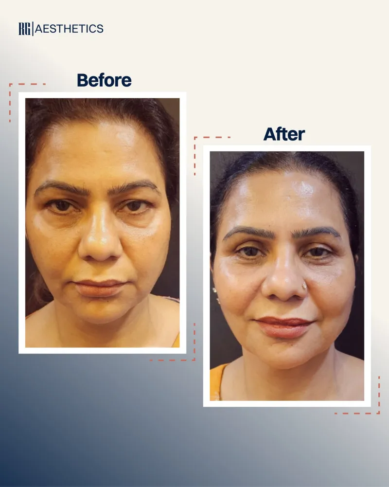 قبل وبعد - Facial Fat Transfer بواسطة د. Rajat Gupta