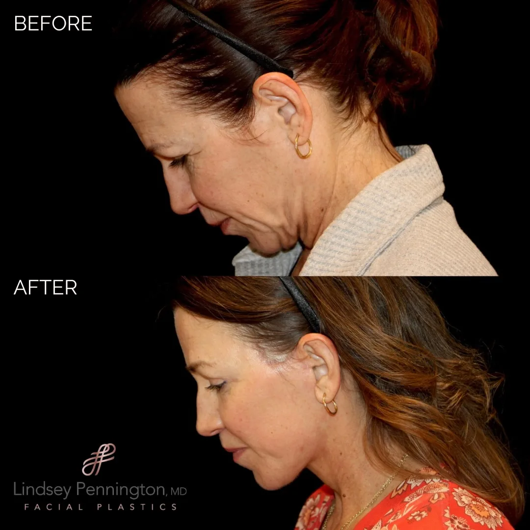 Before and after — Dr. Earl Pennington