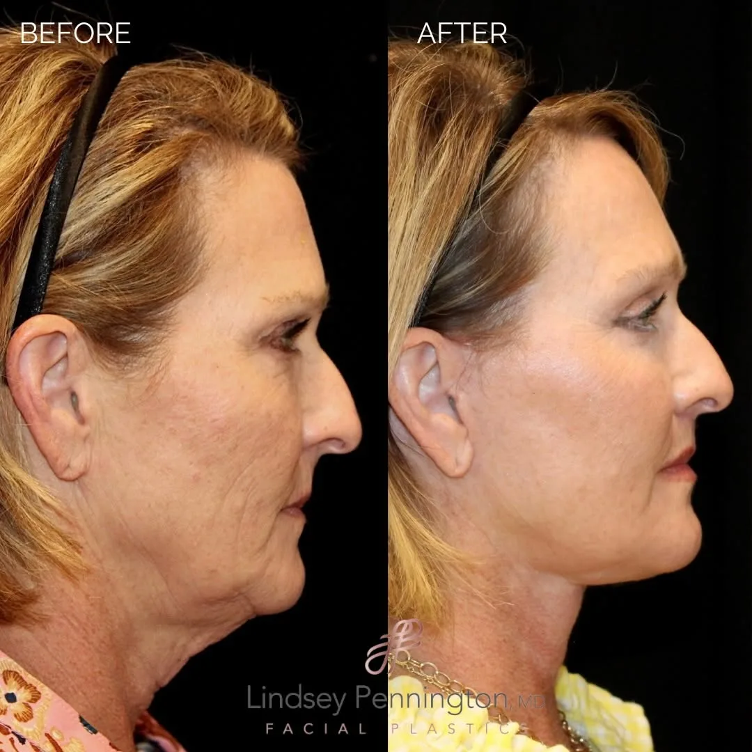 Before and after — Dr. Earl Pennington