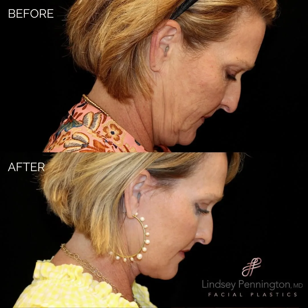 Before and after — Dr. Earl Pennington