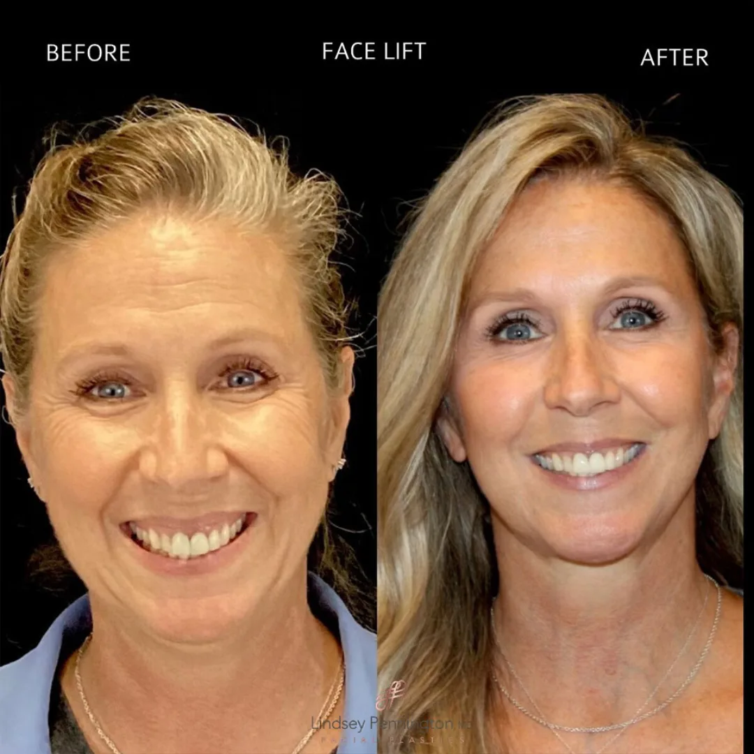 Before and after — Dr. Earl Pennington