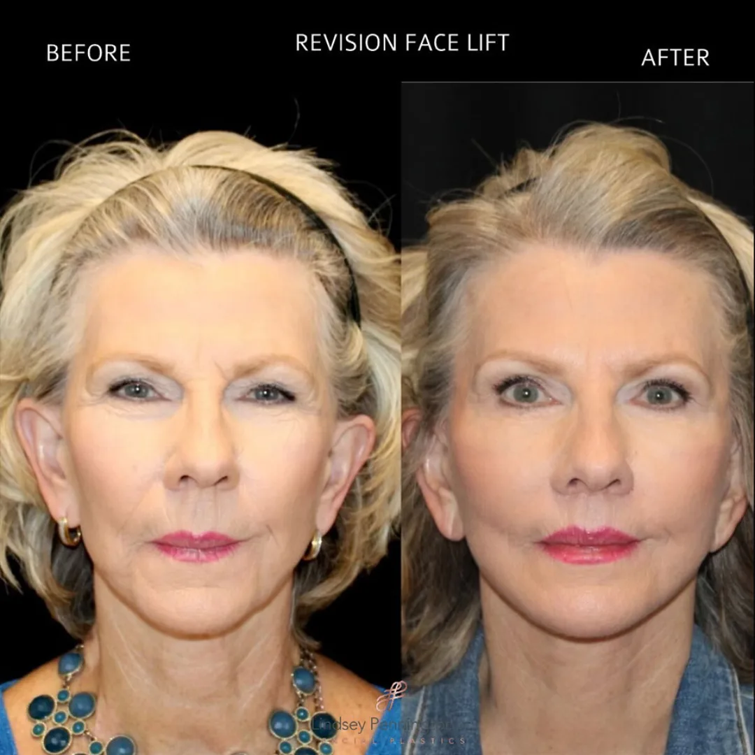 Before and after — Dr. Earl Pennington
