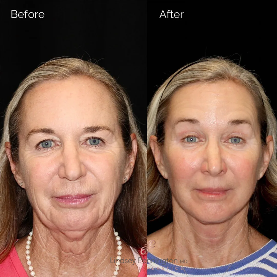 Before and after — Dr. Earl Pennington