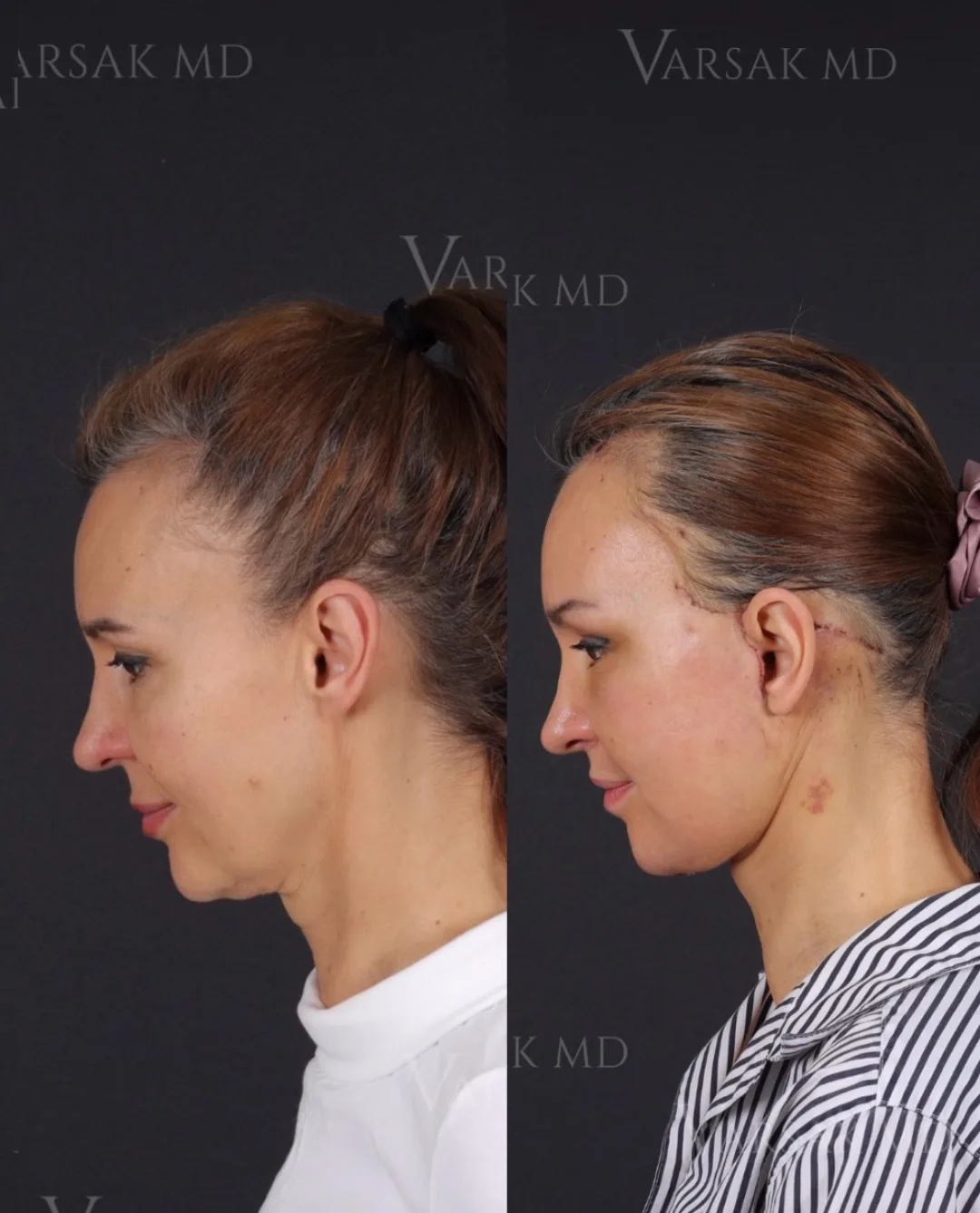 Before and after — Dr. Ediz Varsak