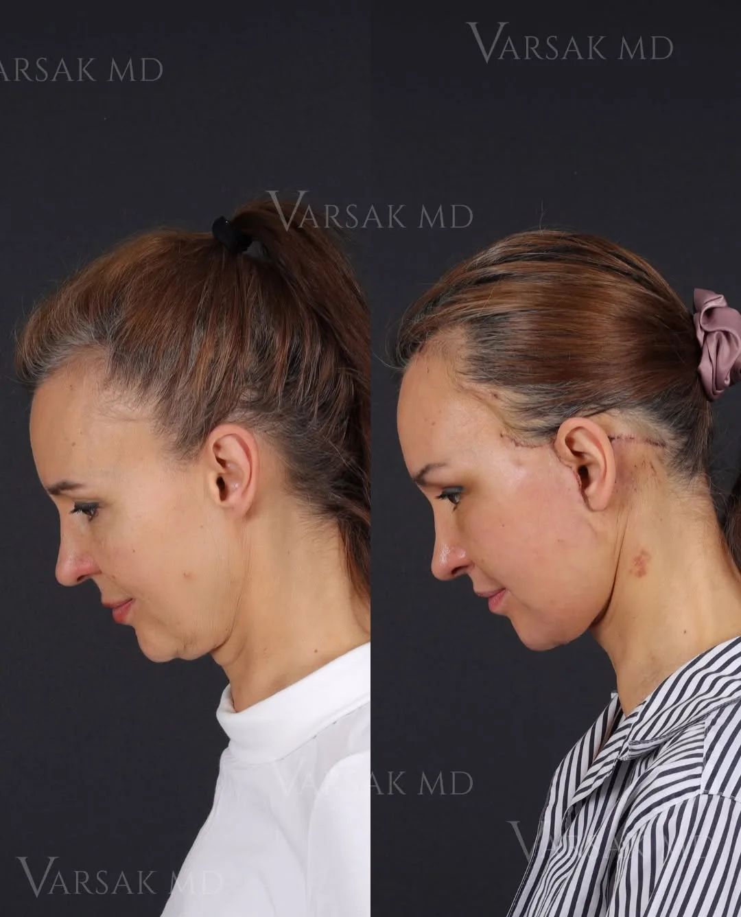 Before and after — Dr. Ediz Varsak