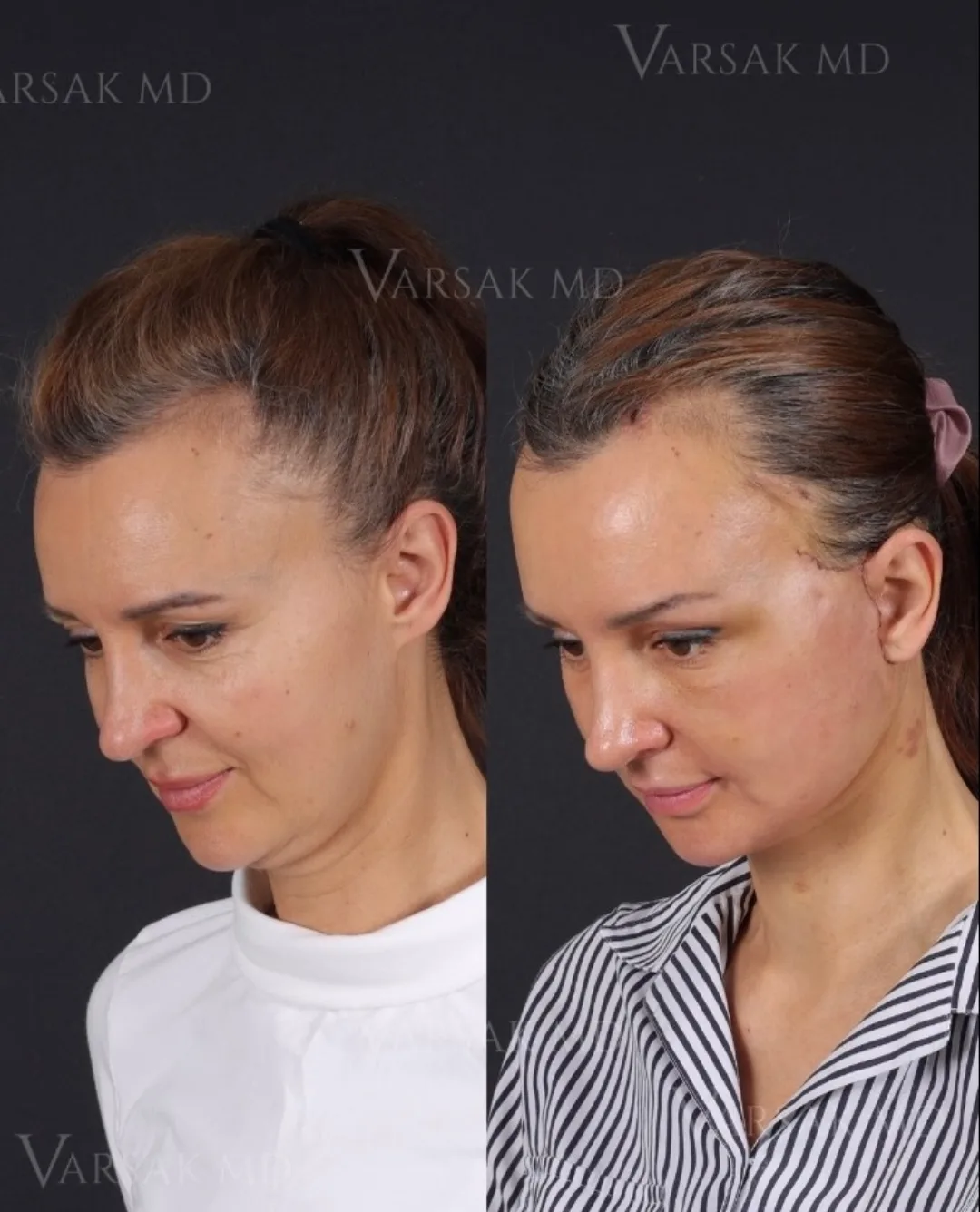 Before and after — Dr. Ediz Varsak