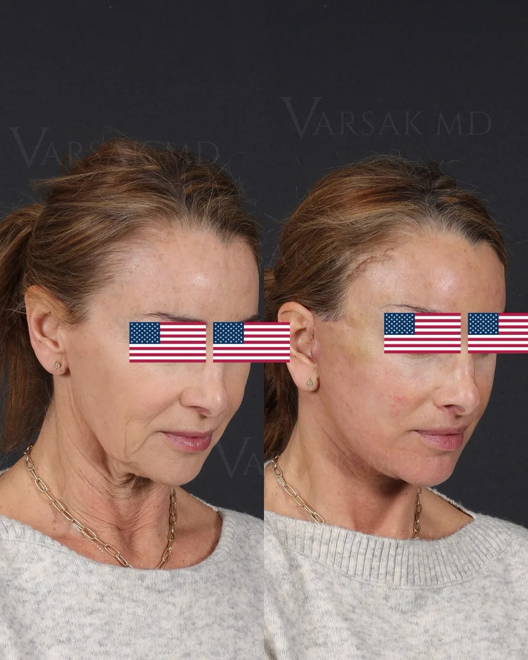 Before and after — Dr. Ediz Varsak