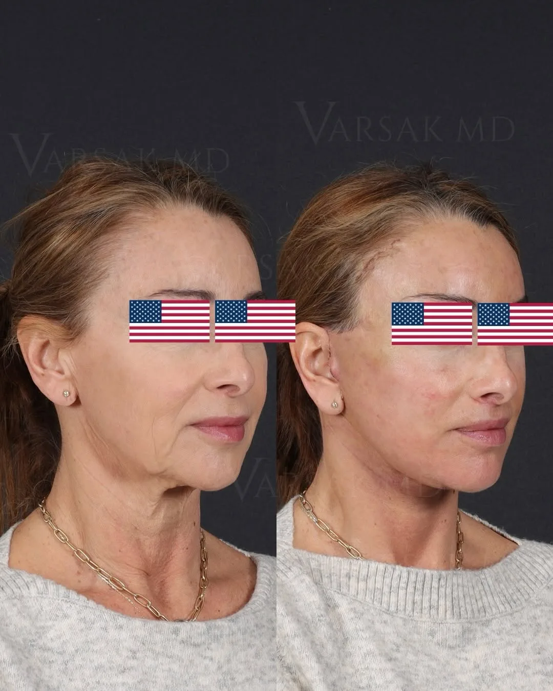 Before and after — Dr. Ediz Varsak
