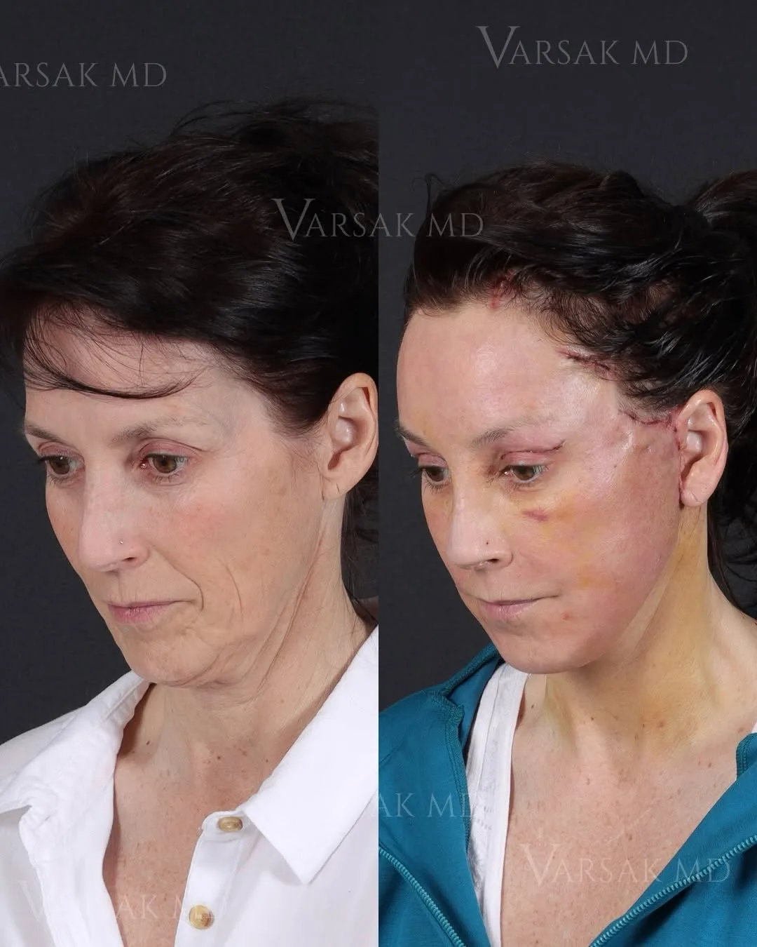 Before and after — Dr. Ediz Varsak