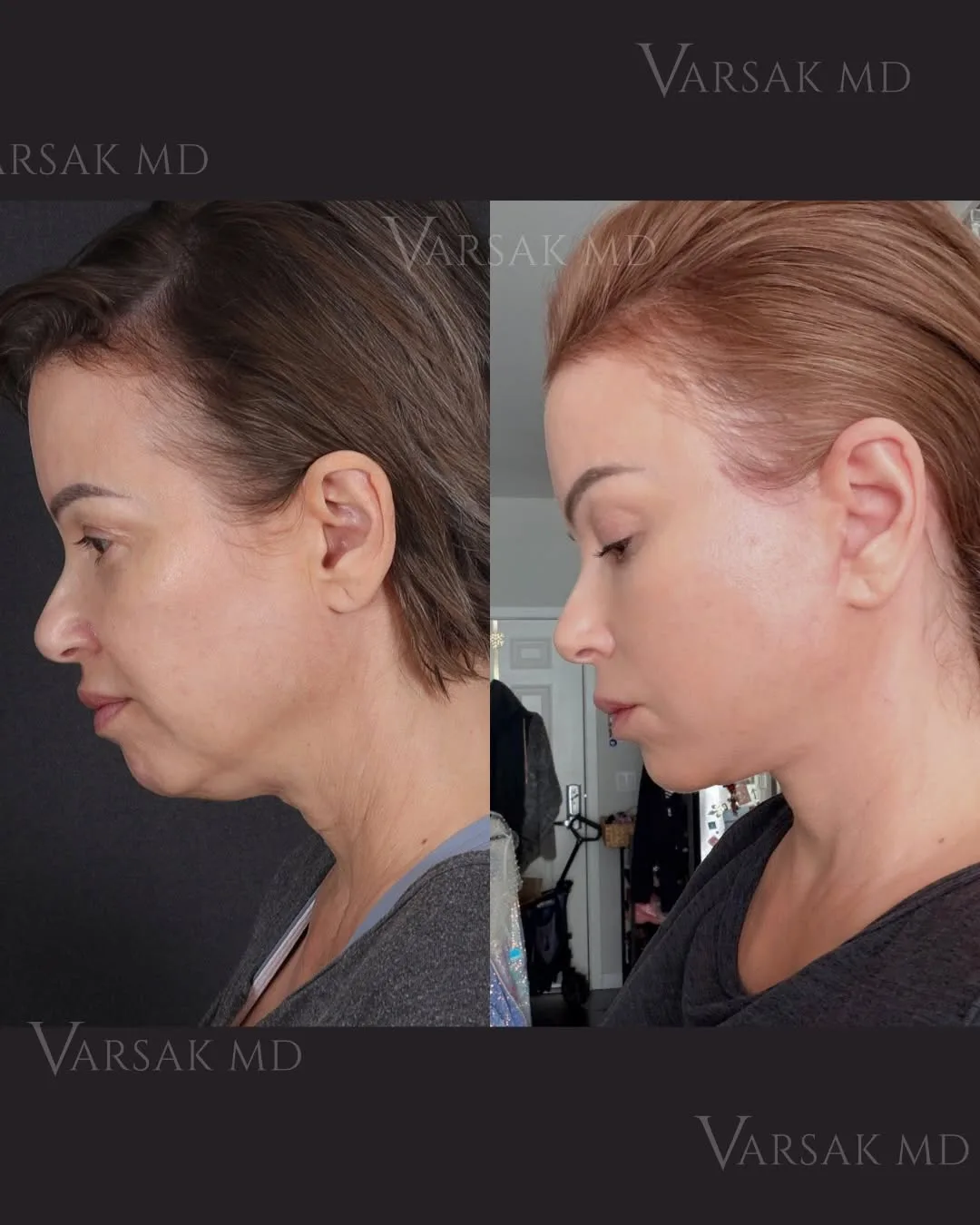 Before and after — Dr. Ediz Varsak