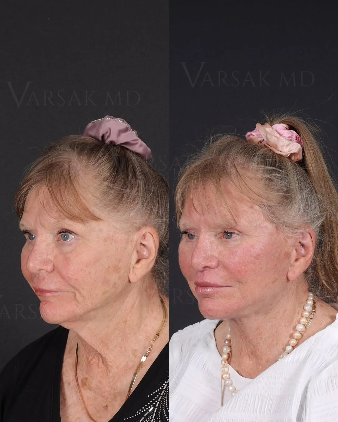 Before and after — Dr. Ediz Varsak