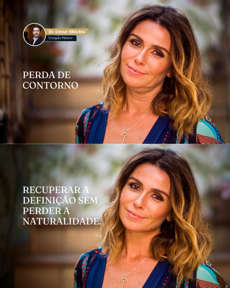 Before & After - Deep Plane Facelift by Dr. Edmar Minchio