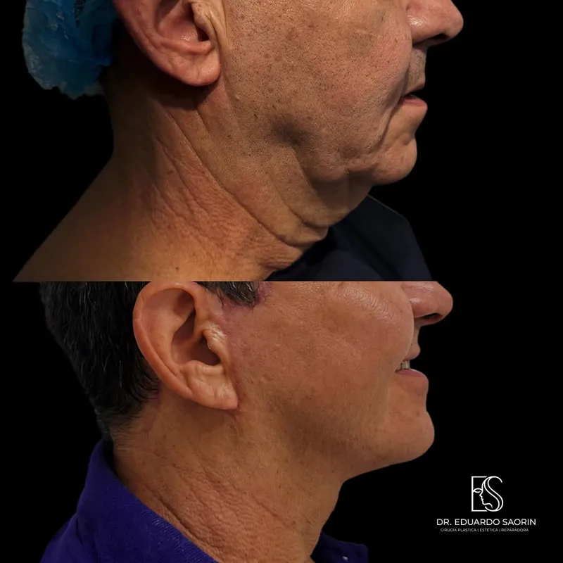Before and after — Dr. Eduardo Saorin