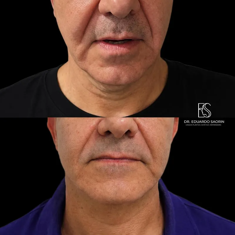 Before and after — Dr. Eduardo Saorin
