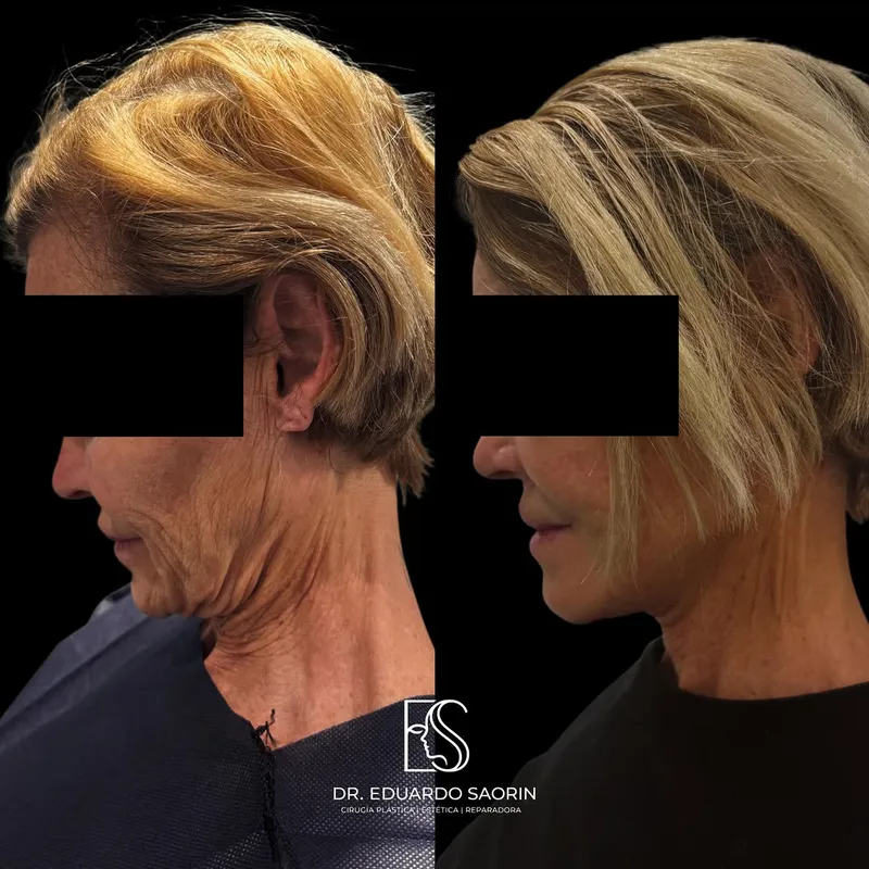 Before and after — Dr. Eduardo Saorin