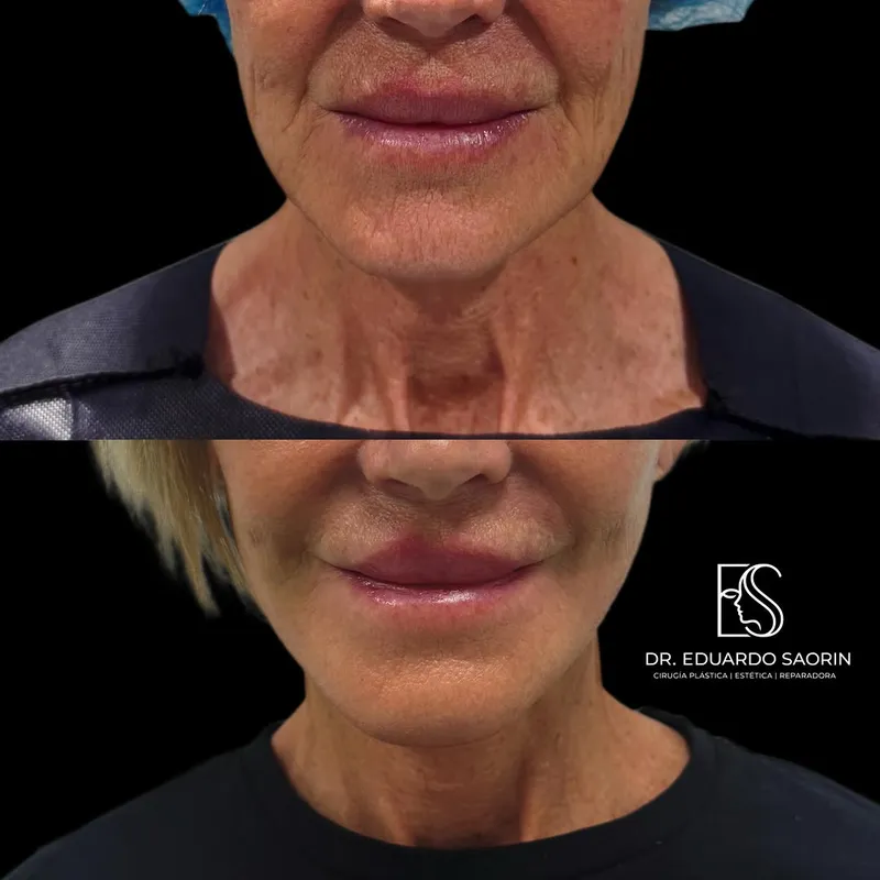 Before and after — Dr. Eduardo Saorin