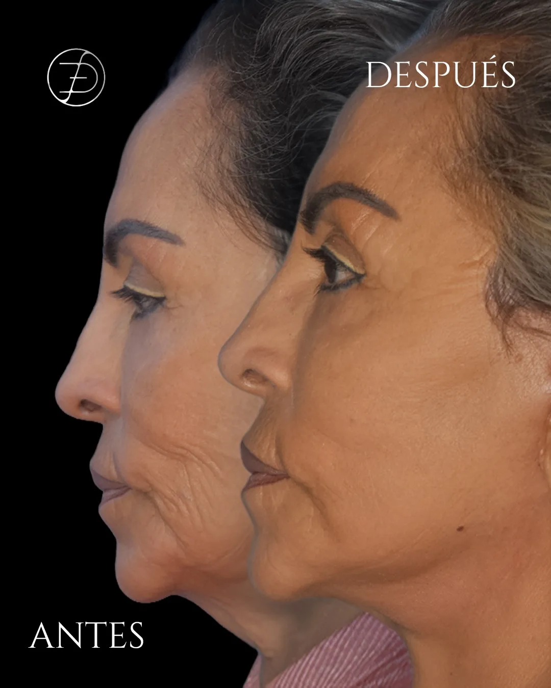Before and after deep plane facelift — 52-year-old woman, left profile view, 12mo post-op by Dr. Efrain Davalos