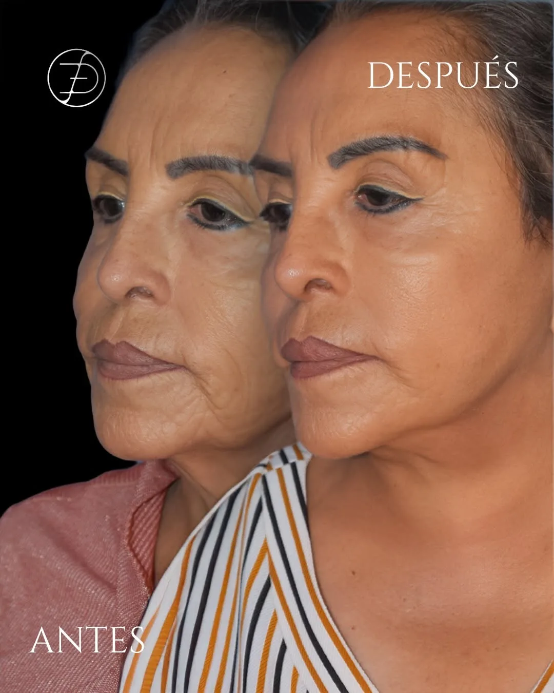 Before and after deep plane facelift — 58-year-old woman, three-quarter view, 6mo post-op by Dr. Efrain Davalos