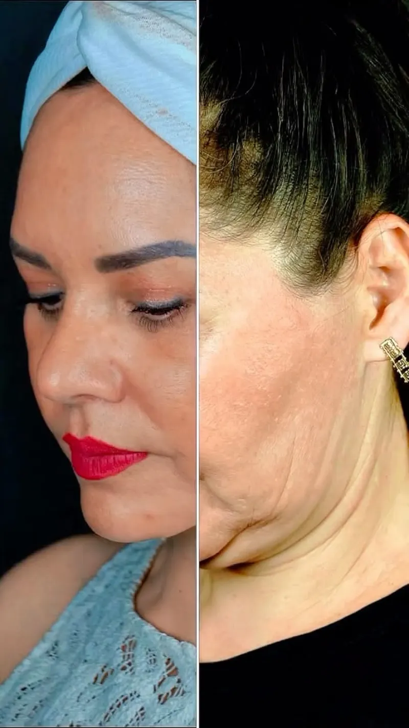 قبل وبعد - Deep Plane Facelift بواسطة د. Einar Mondragon